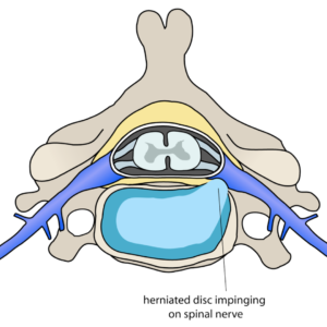 Herniated Disc