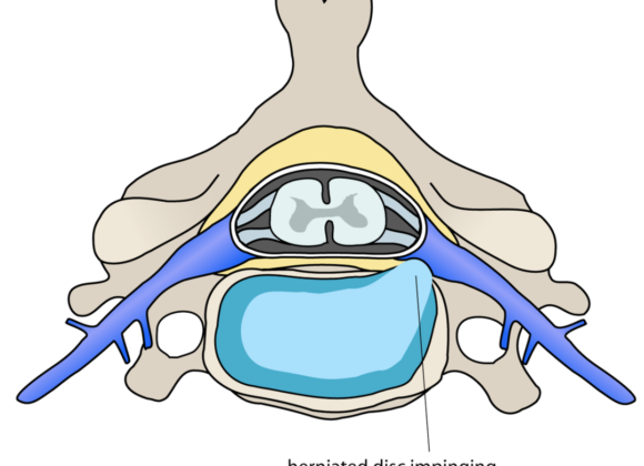 Herniated Disc