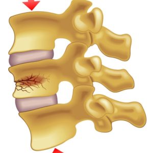 Spinal Fracture