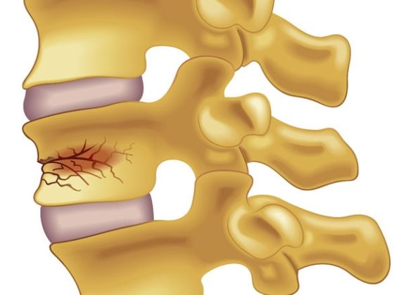 Spinal Fracture