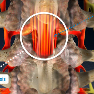 Spinal Stenosis