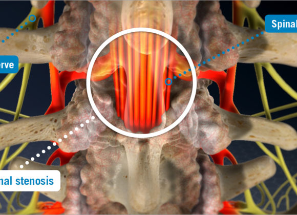 Spinal Stenosis