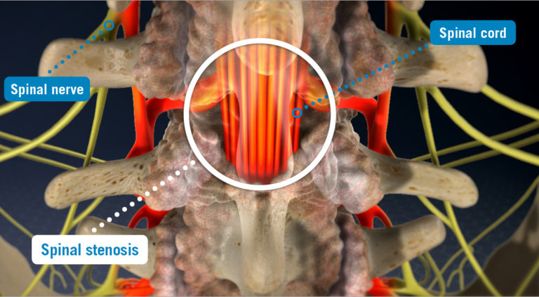 Spinal Stenosis Sarasota Spine Specialists
