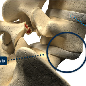 Spondylolisthesis