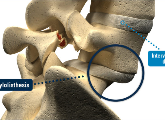 Spondylolisthesis